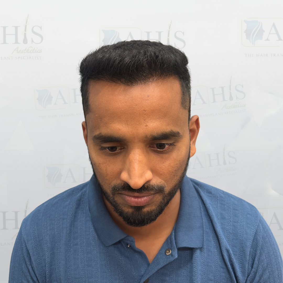 Frontal hairline restoration — after hair transplant at AHIS Aesthetics Mysore