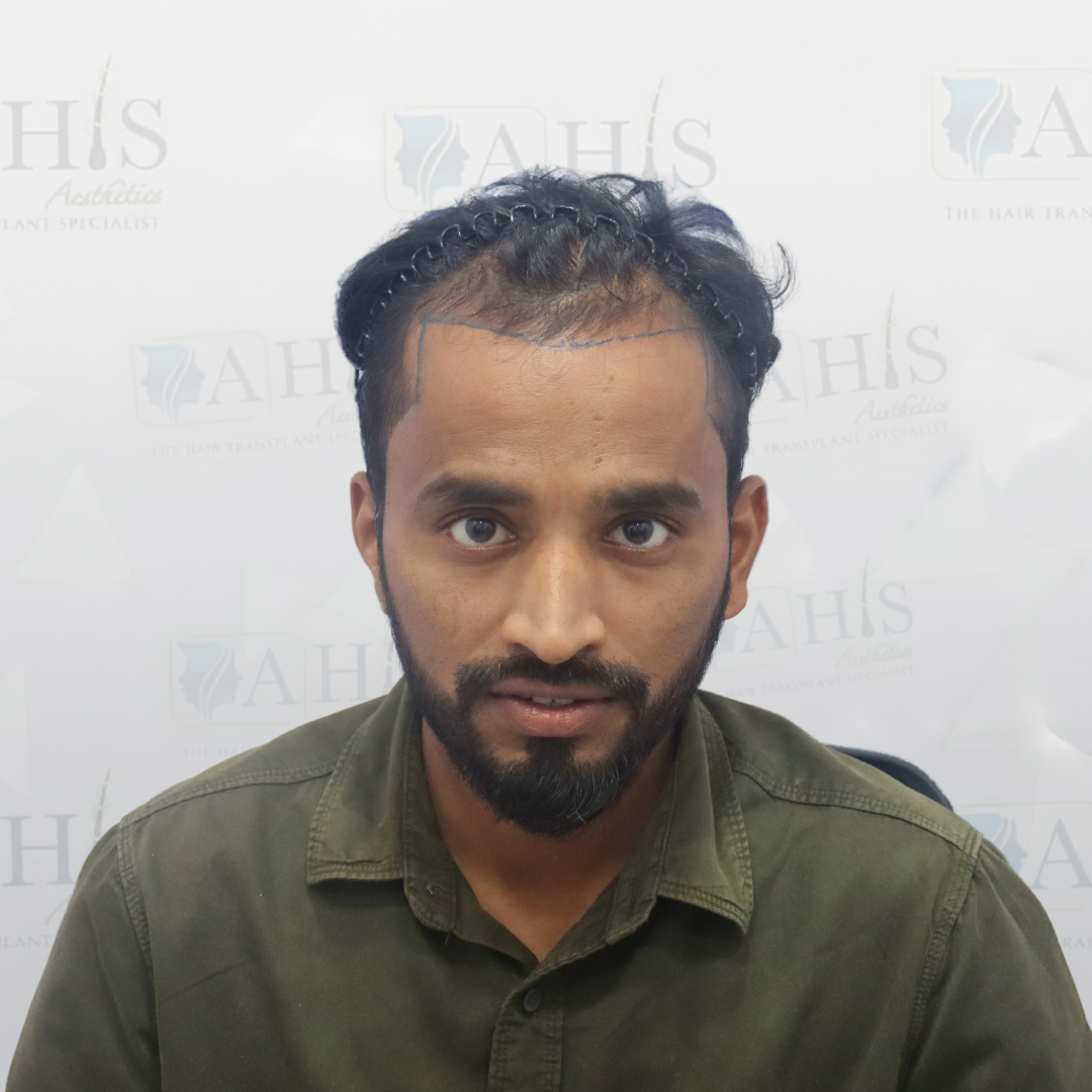 Frontal hairline restoration — before hair transplant at AHIS Aesthetics Mysore